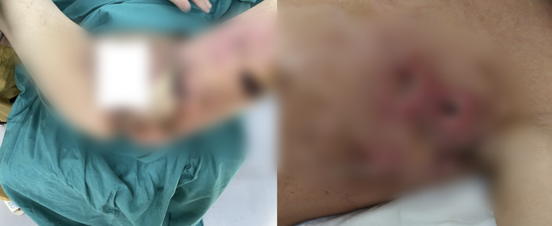 Hình ảnh nhiễm trùng hoại tử da của 2 bệnh nhân (Ảnh - BVCC)