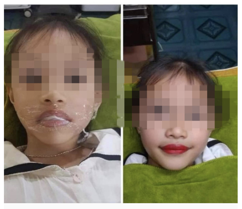 Bé gái 5 tuổi phun môi thẩm mỹ khiến dư luận dậy sóng (Ảnh trên mạng) Bé gái 5 tuổi phun môi thẩm mỹ khiến dư luận dậy sóng (Ảnh trên mạng)
