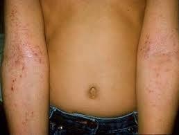 Hình ảnh da trẻ bị viêm da cơ địa (Ảnh - BVCC)