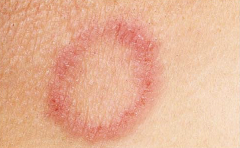Hình ảnh bệnh giang mai (Ảnh - BVCC)