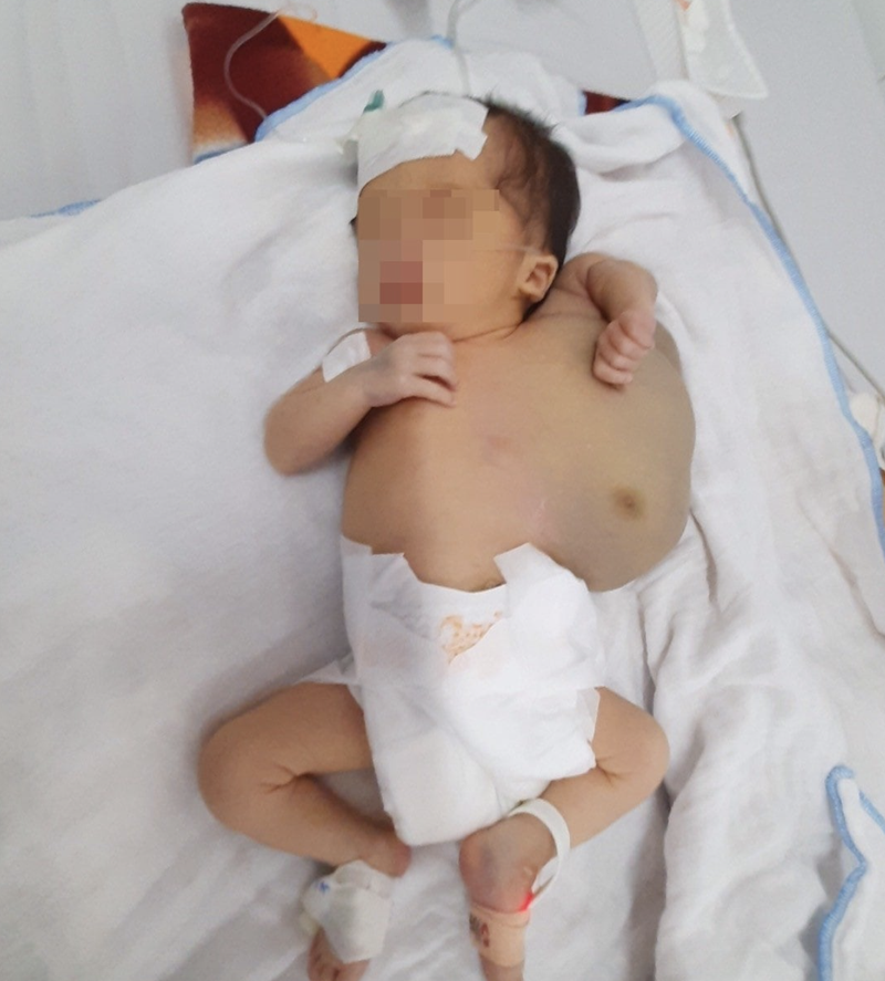 Khối u khổng lồ chèn ép cơ thể bé (Ảnh - BVCC) Khối u khổng lồ chèn ép cơ thể bé (Ảnh - BVCC)