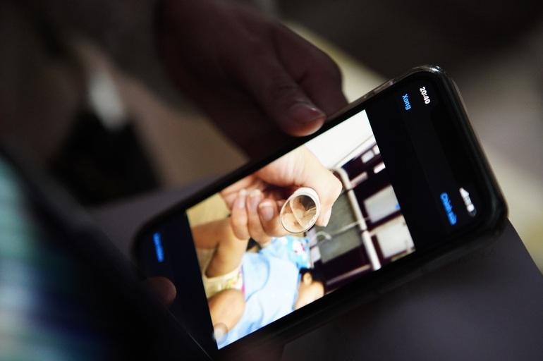 Hình ảnh dị vật ở mũi bé A. trong lần điều trị tại Bệnh viện Nhi Trung ương.