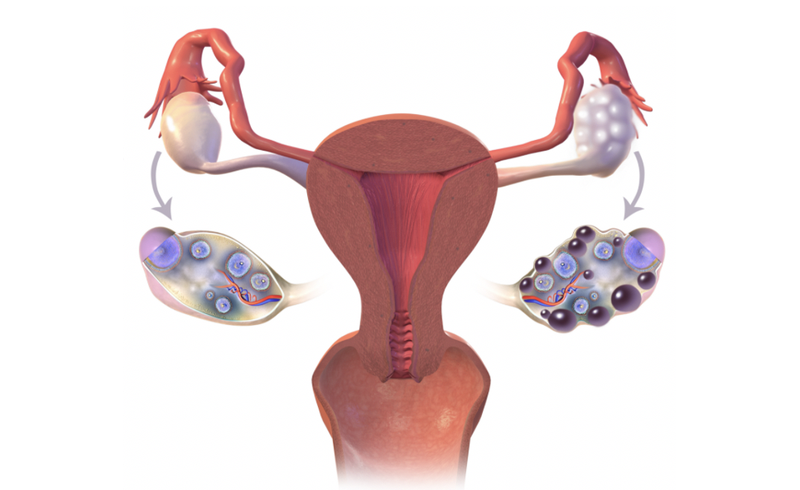 Hình ảnh so sánh buồng trứng đa nang (bên phải) và buồng trứng bình thường (bên trái) (Ảnh - BVCC)