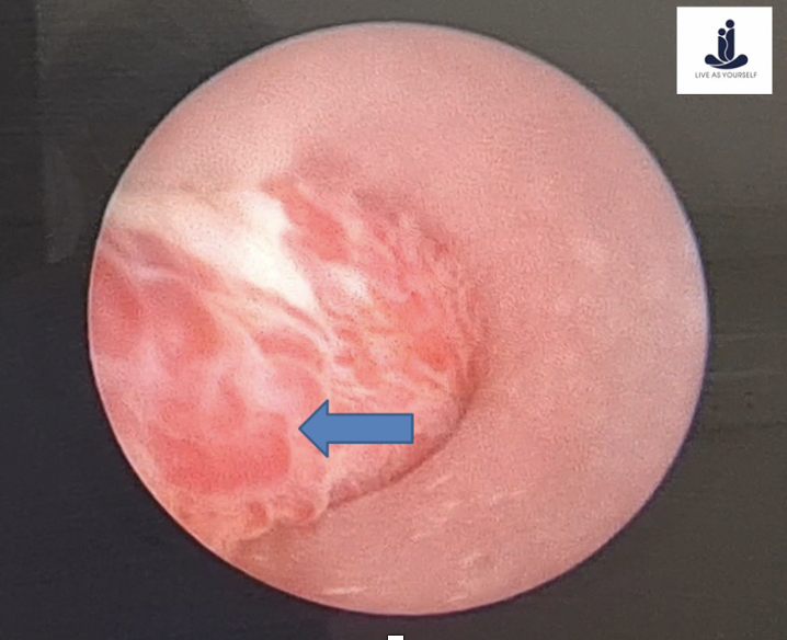 Hình ảnh đám mạch máu niệu đạo giãn lớn qua nội soi niệu đạo ngược dòng (Ảnh - Khoa Nam học và Y học Giới tính)