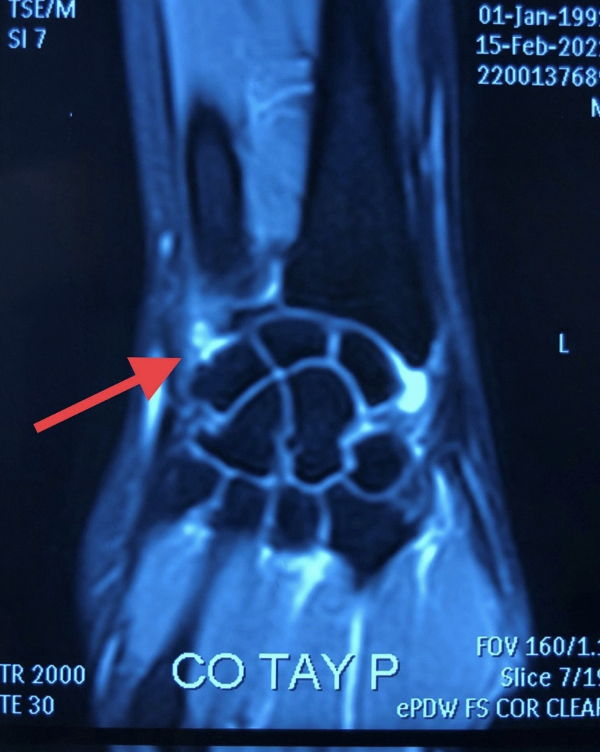 Hình ảnh tổn thương phức hợp dây chằng sụn sợi tam giác TFCC trên phim MRI (Ảnh - BVCC) Hình ảnh tổn thương phức hợp dây chằng sụn sợi tam giác TFCC trên phim MRI (Ảnh - BVCC)