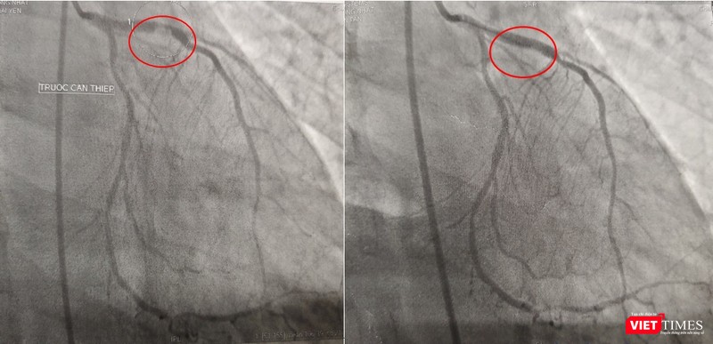Kết quả chụp DSA mạch vành: bán tắc đoạn gần LAD do huyết khối, can thiệp và đặt stent cho bệnh nhân Kết quả chụp DSA mạch vành: bán tắc đoạn gần LAD do huyết khối, can thiệp và đặt stent cho bệnh nhân