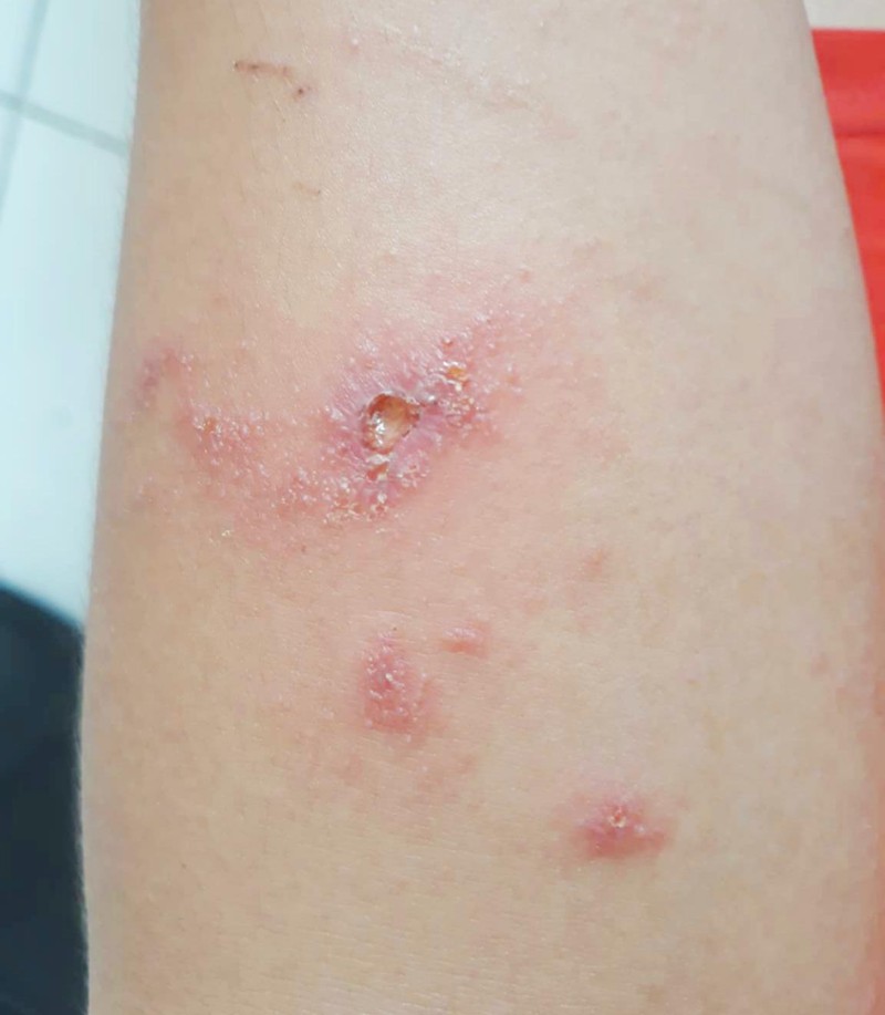 Chất độc của kiến ba khoang tiết ra gây ra những vết bỏng, lở loét sâu (Ảnh: Đ. V. L.) Vết thương căn