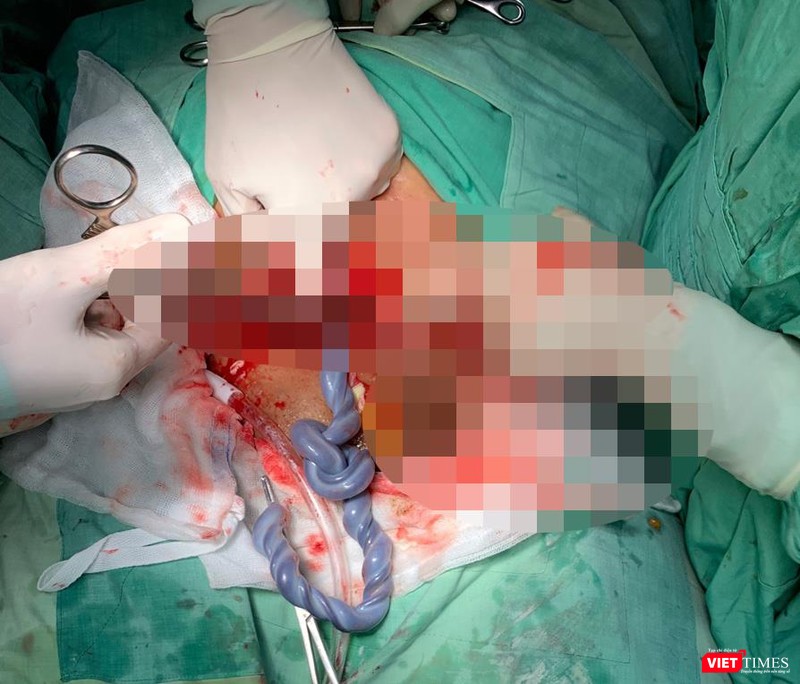 Hình ảnh dây rốn thắt nút Hình ảnh dây rốn thắt nút