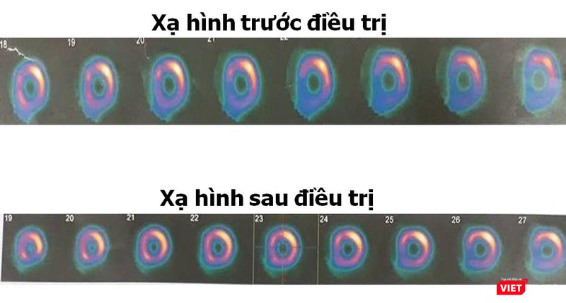 Chụp xạ hình cơ tim sau trị liệu thấy cải thiện mức độ sống còn cơ tim Chụp xạ hình cơ tim sau trị liệu thấy cải thiện mức độ sống còn cơ tim