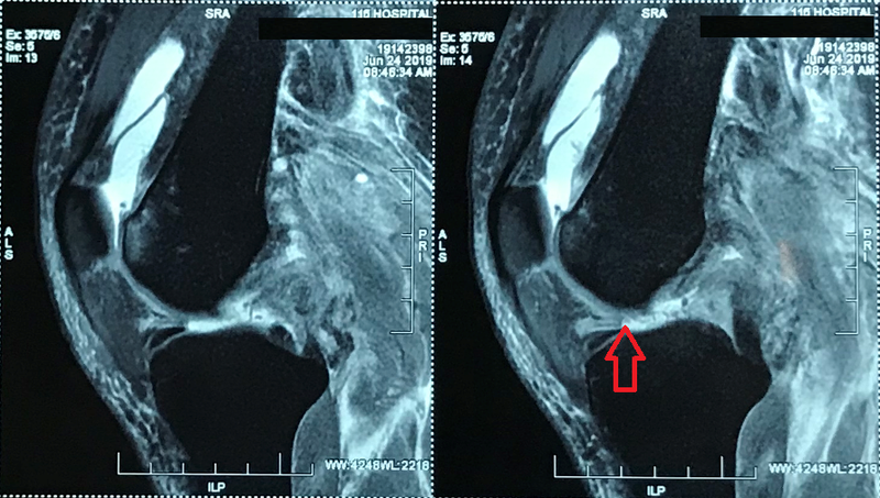 Hình ảnh bị đứt nhiều dây chằng khớp gối trái của bệnh nhân trước khi mổ Hình ảnh bị đứt nhiều dây chằng khớp gối trái của bệnh nhân trước khi mổ