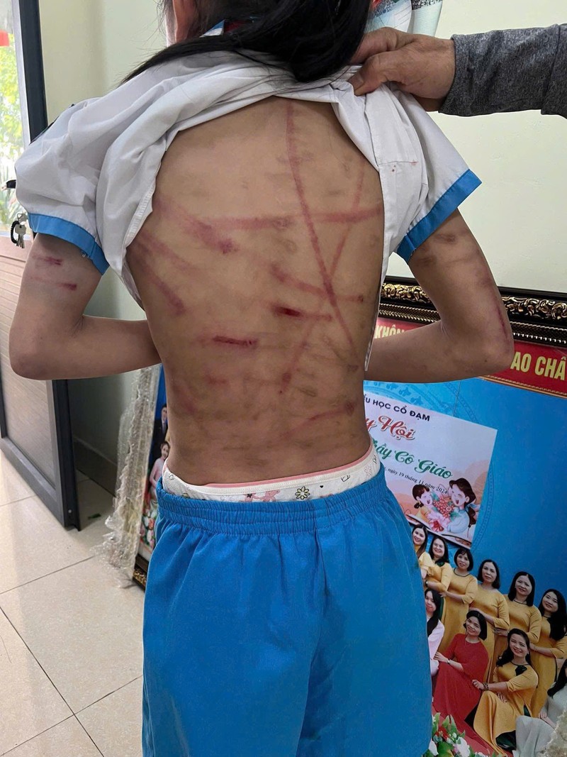 Hình ảnh cháu L với những vết thương do Nguyễn Văn Nam bạo hành: Ảnh: Thùy Dung. Anh 1.jpeg