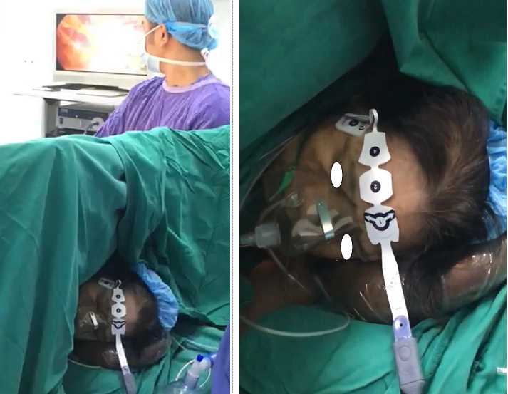 Bệnh nhân phẫu thuật bằng phương pháp gây mê không cần thở máy Bệnh nhân phẫu thuật bằng phương pháp gây mê không cần thở máy