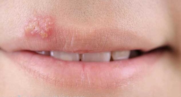 HPV là một bệnh lây truyền qua đường tình dục rất phổ biến (STI). Ảnh: Womenhealthlines