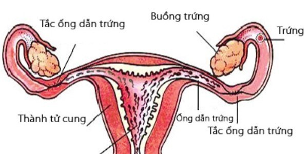 Các bệnh lý phụ khoa dẫn là một trong những nguyên nhâm thầm lặng dẫn đến vô sinh hiếm muộn Các bệnh lý phụ khoa dẫn là một trong những nguyên nhâm thầm lặng dẫn đến vô sinh hiếm muộn