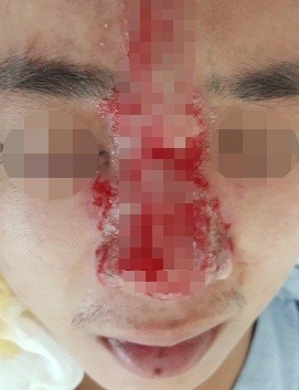 Bệnh nhân gặp biến chứng hoại tử da mũi, mắt bị mờ - Ảnh: BVCC Bệnh nhân gặp biến chứng hoại tử da mũi, mắt bị mờ - Ảnh: BVCC