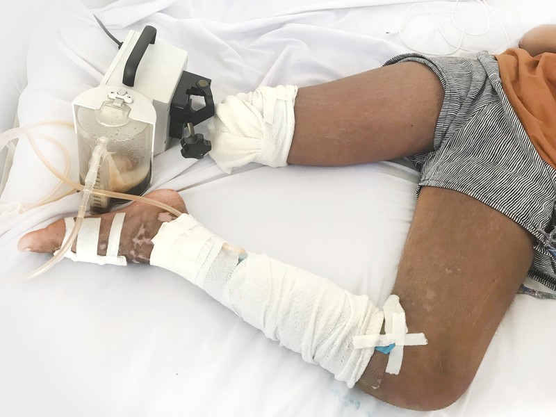 Bệnh nhi bị cắt chân vì cách chữa trị rắn cắn sai lầm. Bệnh nhi bị cắt chân vì cách chữa trị rắn cắn sai lầm.