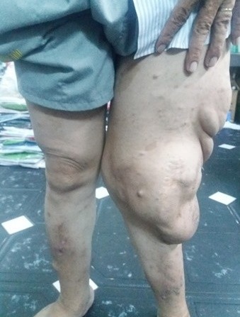 Bệnh nhân Ph.Tr.M. mang khối u bướu thần kinh khổng lồ suốt 20 năm. Ảnh: BVCC Bệnh nhân Ph.Tr.M. mang khối u bướu thần kinh khổng lồ suốt 20 năm. Ảnh: BVCC