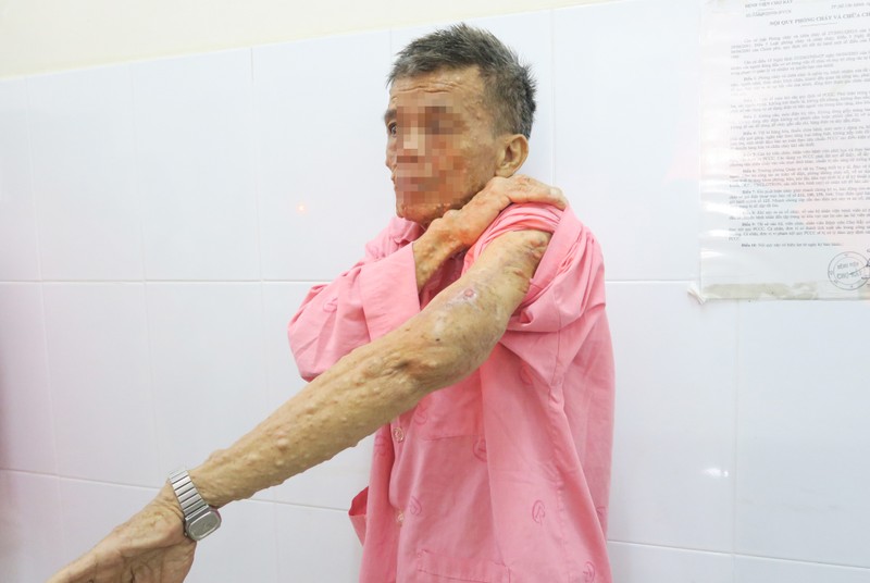 Bệnh nhân cảm thấy nhẹ nhõm, sinh hoạt thuận tiện hơn sau khi được phẫu thuật cắt bỏ khối u bướu thần kinh. Ảnh: BVCC Bệnh nhân cảm thấy nhẹ nhõm, sinh hoạt thuận tiện hơn sau khi được phẫu thuật cắt bỏ khối u bướu thần kinh. Ảnh: BVCC