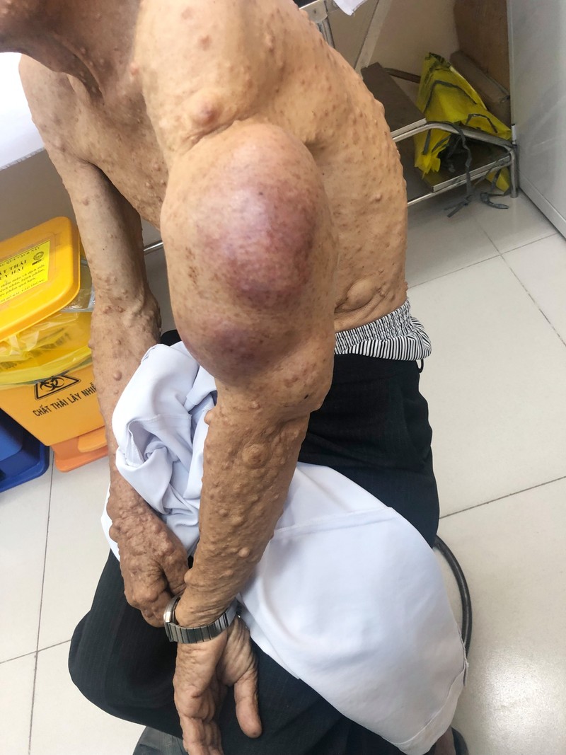 Bệnh nhân Đ.V.H. bị khối bướu thần kinh ở cánh tay suốt mấy chục năm trời, gây nhiều khó khăn trong sinh hoạt và mỗi ngày thêm đau nhức. Ảnh: BVCC Bệnh nhân Đ.V.H. bị khối bướu thần kinh ở cánh tay suốt mấy chục năm trời, gây nhiều khó khăn trong sinh hoạt và mỗi ngày thêm đau nhức. Ảnh: BVCC