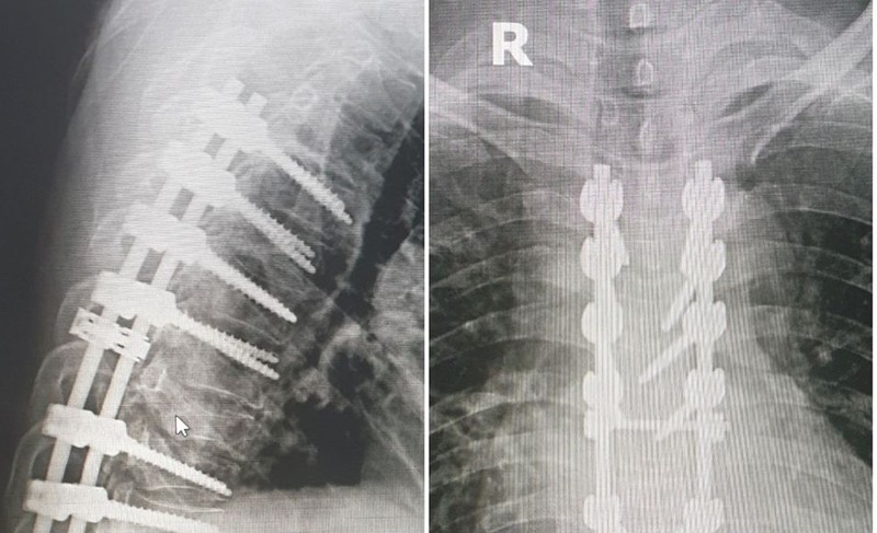 Hình ảnh chụp X quang kết quả phẫu thuật bắt vít kết hợp xương làm cứng cột sống ngực cho bệnh nhân. Ảnh: BVCC Hình ảnh chụp X quang kết quả phẫu thuật bắt vít kết hợp xương làm cứng cột sống ngực cho bệnh nhân. Ảnh: BVCC