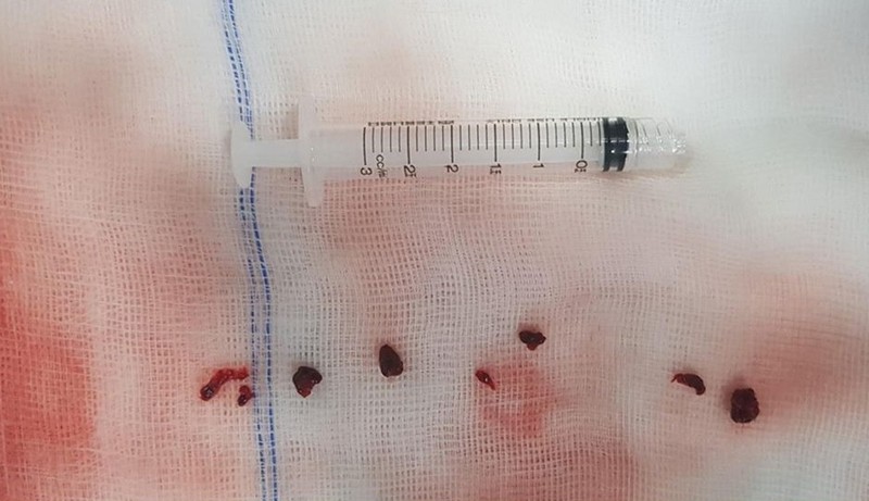 Huyết khối gây tắc mạch máu não của bệnh nhân T. T.A Huyết khối gây tắc mạch máu não của bệnh nhân T. T.A