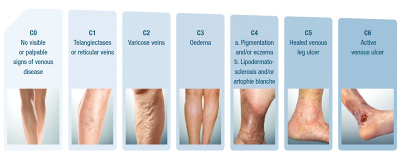 Bệnh suy tĩnh mạch có 6 giai đoạn. Ảnh: Jobst Bệnh suy tĩnh mạch có 6 giai đoạn. Ảnh: Jobst