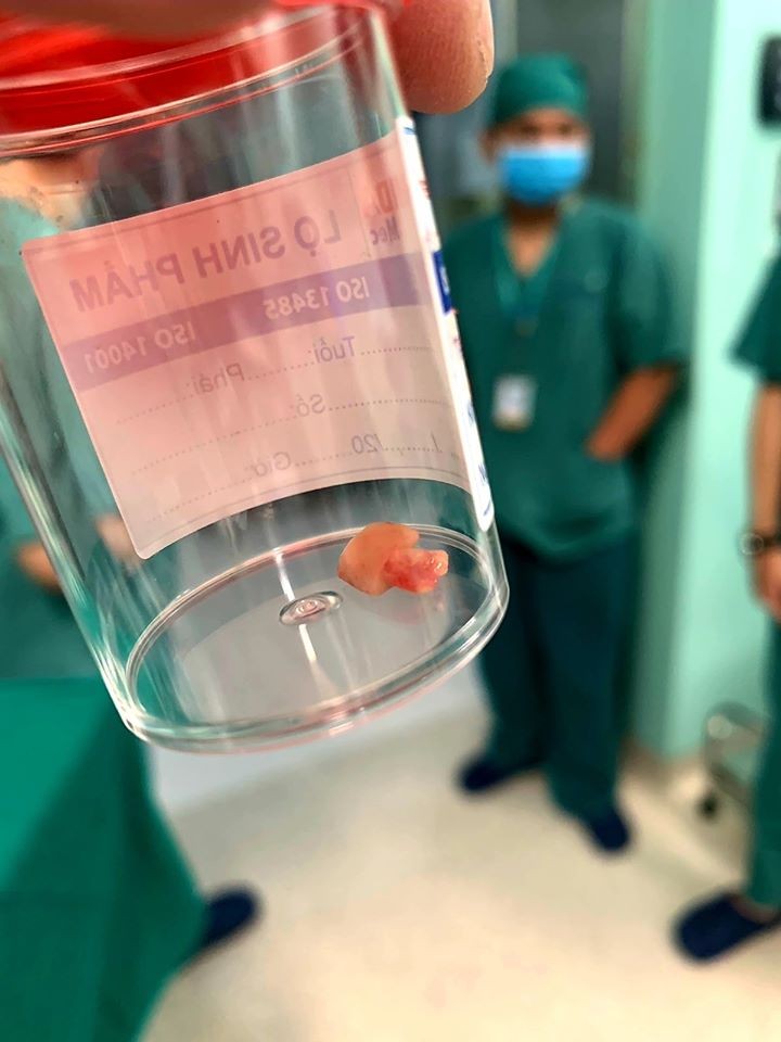 Dị vật được lấy ra khỏi đường thở của trẻ. Ảnh: BVCC Dị vật được lấy ra khỏi đường thở của trẻ. Ảnh: BVCC