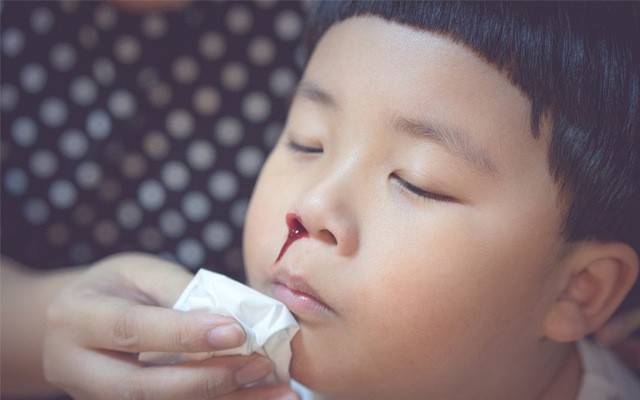 Những triệu chứng ban đầu của bệnh u sợi mạch vòm mũi họng là trẻ dễ bị chảy máu cam khi hắt hơi. Ảnh minh họa: Internet Những triệu chứng ban đầu của bệnh u sợi mạch vòm mũi họng là trẻ dễ bị chảy máu cam khi hắt hơi. Ảnh minh họa: Internet