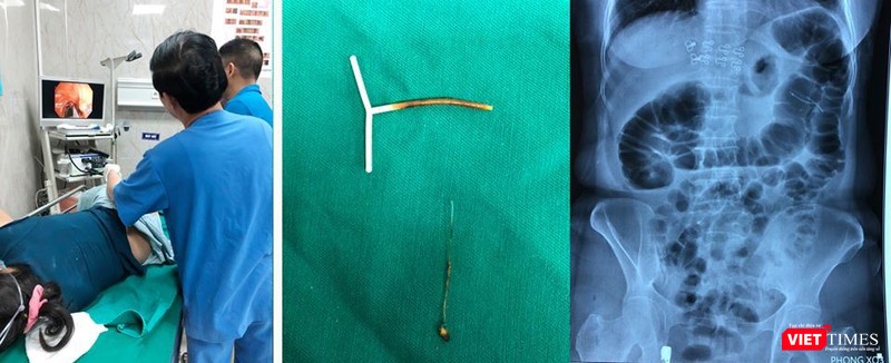 Dị vật là vòng tránh thai đã được lấy ra khỏi đại tràng bệnh nhân. Ảnh: BVCC