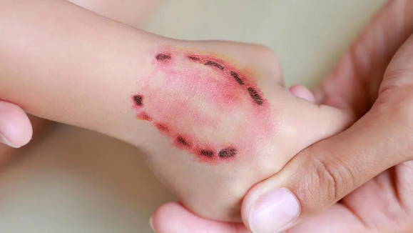 TP.HCM: Số ca bệnh tay chân miệng liên tục gia tăng, cha mẹ nên làm gì để bảo vệ trẻ? ảnh 5 Bệnh dại ở người: Thoát khỏi nguy cơ tử vong nhờ điều trị đúng cách