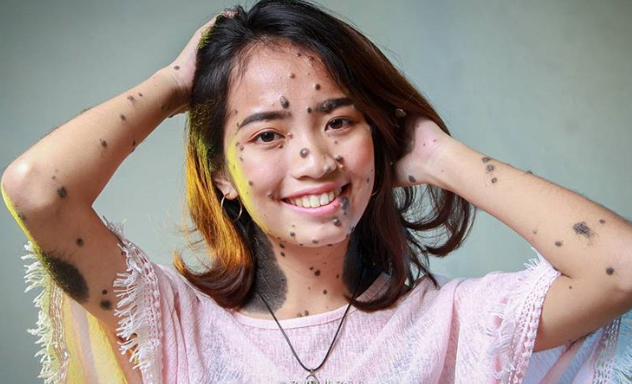 Những cách trị gàu đơn giản, ít tốn kém mà hiệu quả bất ngờ ảnh 12 8 câu chuyện khiến bạn thay đổi quan niệm về cái đẹp