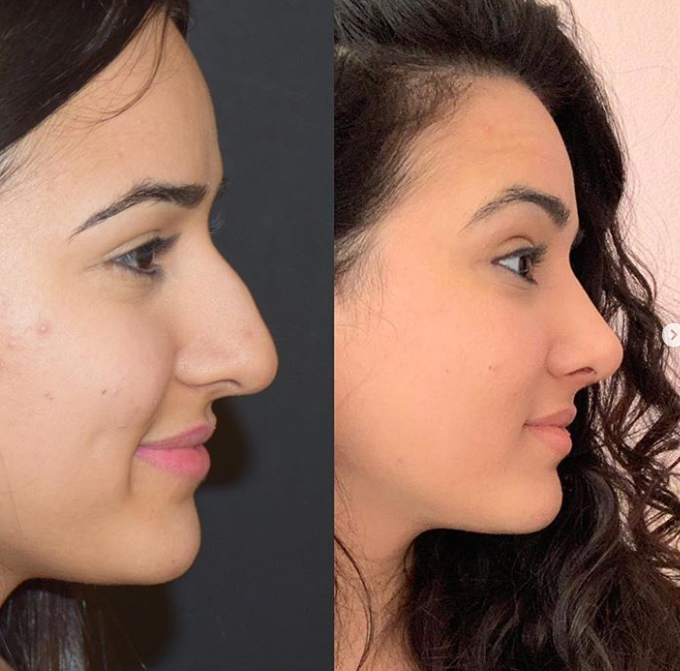 Hiện tại, thủ thuật sửa mũi được thực hiện vô cùng đơn giản. Ảnh: BrightSide Ảnh: BrightSide