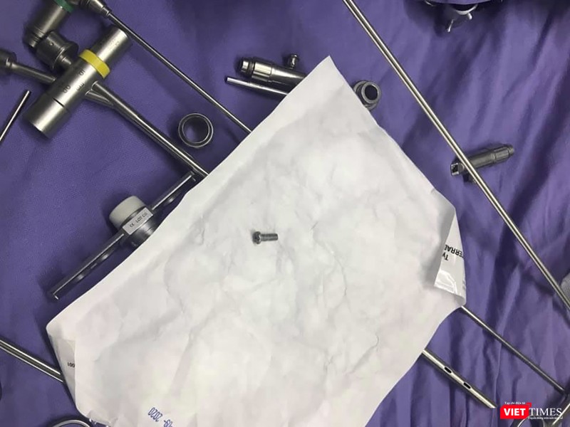 Đinh vít nằm ở đường thở của bệnh nhân nhi tên N. ở Quảng Nam sau khi nội soi gắp ra.