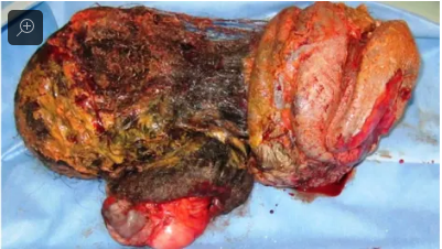 Khối u "bào thai trong bào thai" được các bác sĩ phẫu thuật lấy ra từ ổ bụng cô gái. Ảnh: Gizmodo Ảnh: Gizmodo