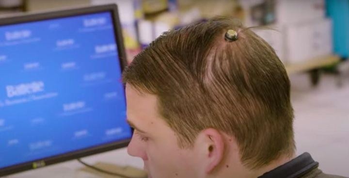 Giao diện não-máy tính yêu cầu một con chip cấy vào não. Ảnh: Bloomberg