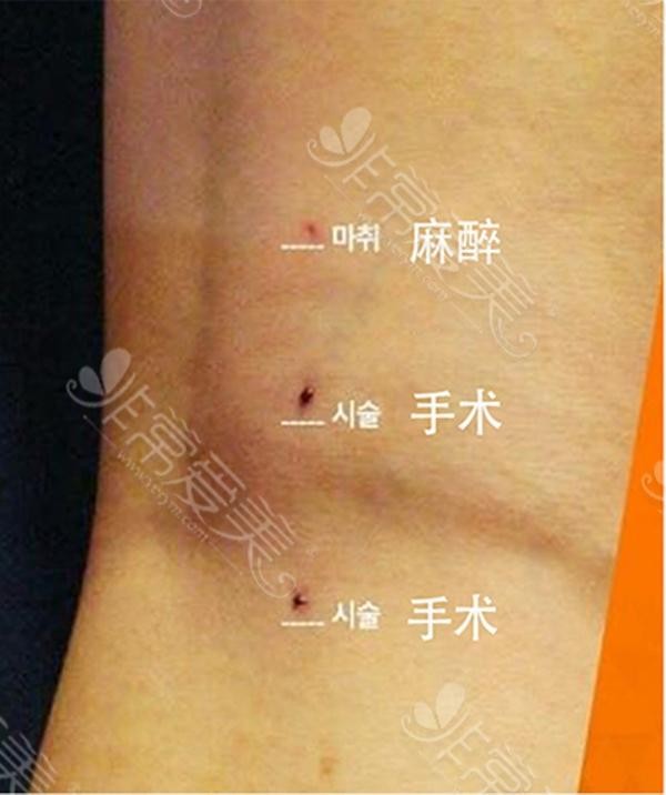 Các thủ thuật cần làm: tiêm thuốc tê (trên) và phẫu thuật nội soi cắt dây thần kinh (giữa và dưới). Ảnh: Sohu.