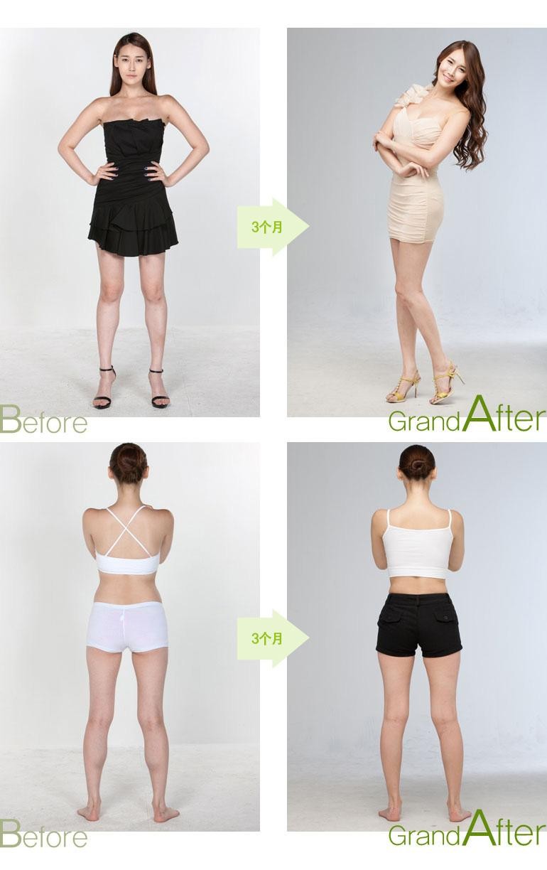 Quảng cáo về hiệu quả của thủ thuật Phong tỏa bắp chân sau 3 tháng (Ảnh: Sohu).