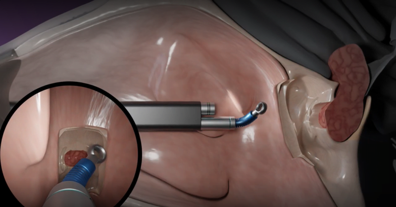 Bức ảnh cho thấy hệ thống Tamar Robotics, được sử dụng để loại bỏ một khối u tuyến yên qua mũi. Trong khoanh tròn là chế độ xem mà bác sĩ phẫu thuật nhìn thấy trên màn hình. Ảnh NoCamels Bức ảnh cho thấy hệ thống Tamar Robotics, được sử dụng để loại bỏ một khối u tuyến yên qua mũi. Trong khoanh tròn là chế độ xem mà bác sĩ phẫu thuật nhìn thấy trên màn hình. Ảnh NoCamels