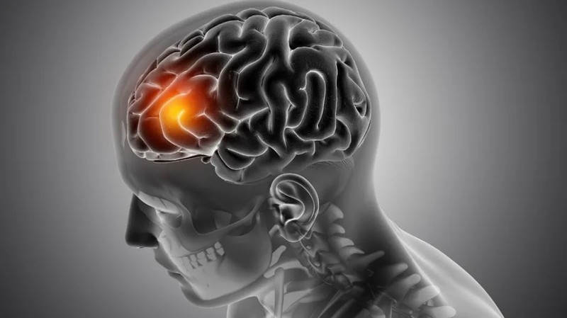 Các nhà khoa học cho thấy một khả năng mới điều trị u nguyên bào thần kinh đệm. Ảnh Euro News. Next