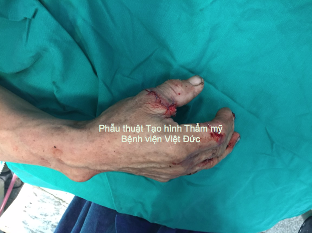 Ngón tay đã được nối bằng vi phẫu thuật (ảnh do BV Việt Đức cung cấp)