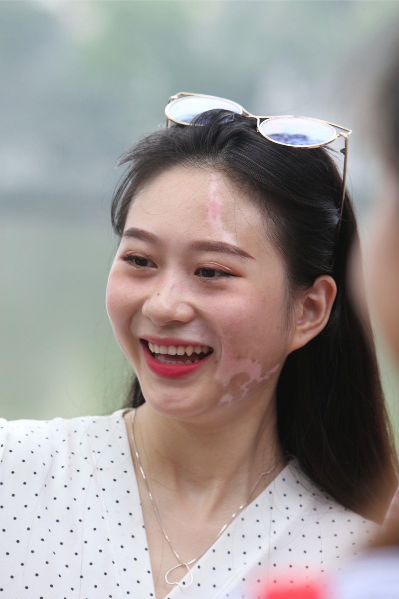 Bệnh bạch biến vẫn chưa có thuốc điều trị khỏi hoàn toàn Bệnh bạch biến vẫn chưa có thuốc điều trị khỏi hoàn toàn