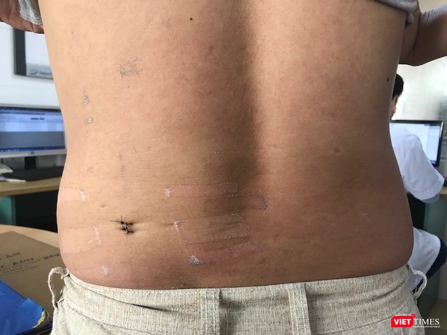 Sau mổ, bệnh nhân hoàn toàn khỏe mạnh, vết mổ nhỏ, ít xâm lấn