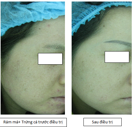 Bệnh nhân điều trị nám má tại Bệnh viện Da liễu Trung ương