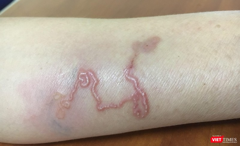 VT_ giun chó mèo.jpg