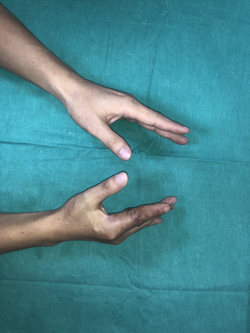 sau mổ 4 tuần.JPG