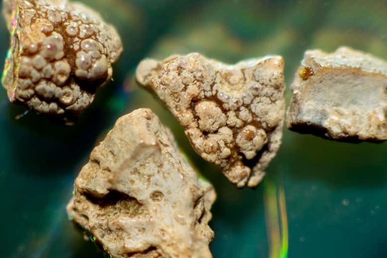 Phương pháp mới giúp loại bỏ sỏi thận không cần phẫu thuật