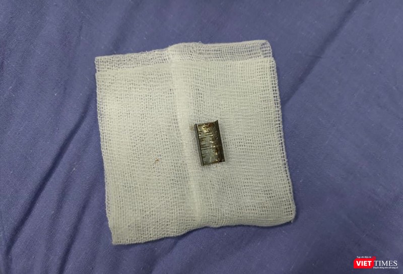 Dị vật mảnh kim loại được nội soi lấy ra từ bệnh nhân nhi nhập viện cấp cứu