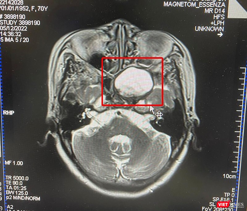 Phim chụp khối u nhầy xoang bướm ở bệnh nhân