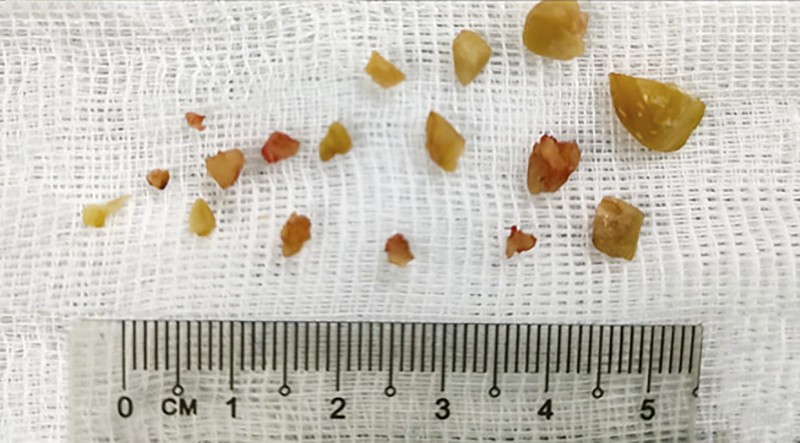 Hình ảnh hạt lạc mắc trong phế quản và được gắp ra ngoài sau khi phá thành nhiều mảnh nhỏ (ảnh BVCC)