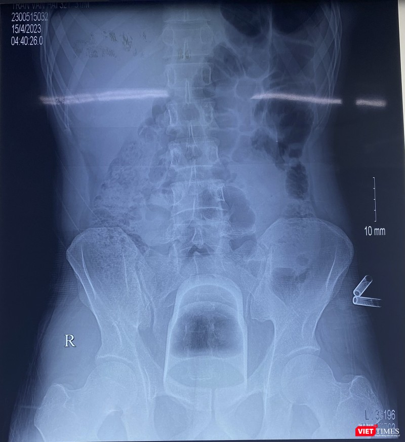 Phim X-quang chiếc cốc đánh răng nằm sâu trong trực tràng của bệnh nhân (ảnh BVCC)